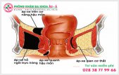 
						Apxe hậu môn là bệnh gì?