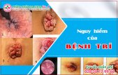 
						Cẩn thận với những dấu hiệu, nguyên nhân gây bệnh trĩ ngoại