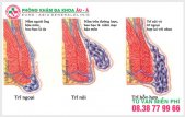 
						Chi phí cho 1 ca chữa trị trĩ hỗn hợp như thế nào?