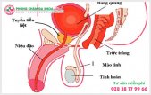 
						Điều trị sỏi tuyến tiền liệt ra sao?