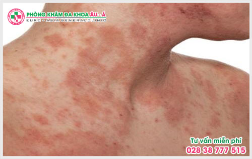 Bệnh chàm hóa da là một loại viêm da mãn tính rất dễ tái phát nếu gặp điều kiện thuận lợi, bệnh do vi nấm dermatophytes gây ra.