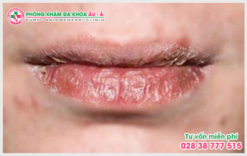 　Theo các chuyên gia da liễu bệnh chàm môi là tình trạng viêm của môi gây nên đau đớn, ngứa ngáy cho người bệnh